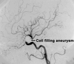 aeurysmcoiled4_angiogram.jpg