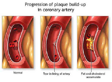 progressive-build-up-of-plaque-in-coronary-artery.jpg